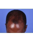 Before Hair Transplant&nbsp;Front
